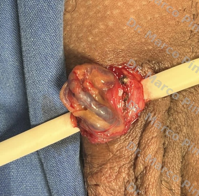 Varicocelectomía microquirúrgica caso 2